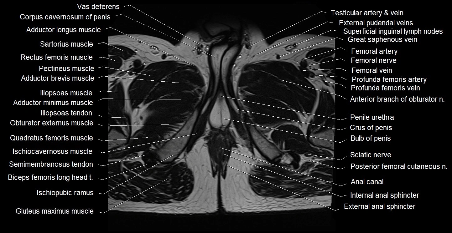 Male pelvis axial cross sectional anatomy image 44.webp
